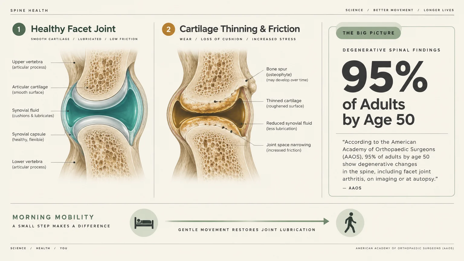 Medical diagram comparing a healthy facet joint to cartilage thinning, beside a 95% statistic and morning mobility graphic.